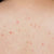 Chest and Back Acne