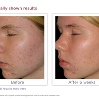 Acne Self Foaming Cleanser