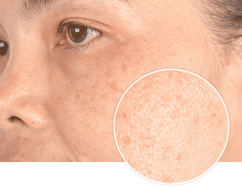 Hyperpigmentation on face due to Melasma - Glytone