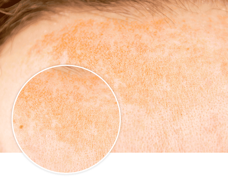 Hyperpigmentation on face due to Lentigo - Glytone