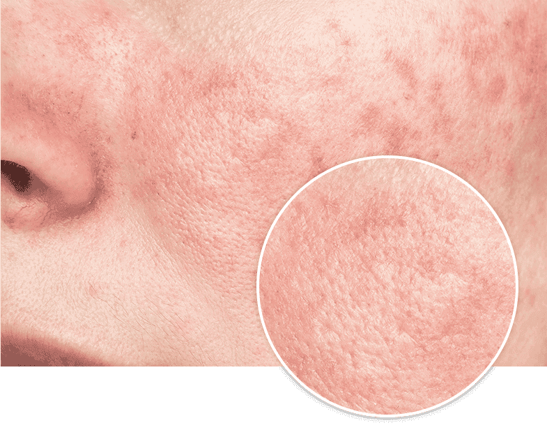 Hyperpigmentation on face due to Post-Inflammatory Hyperpigmentation (PIH) on skin - Glytone